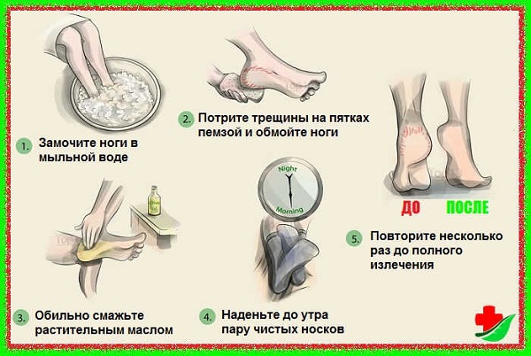 Biện pháp khắc phục cho gót chân nứt nẻ: dân gian với glycerin, amoniac, giấm, trứng, peroxide, lô hội, vitamin E, calendula