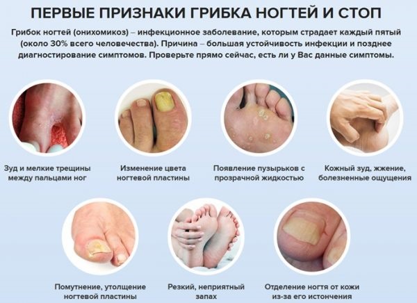 Biện pháp khắc phục cho gót chân nứt nẻ: dân gian với glycerin, amoniac, giấm, trứng, peroxide, lô hội, vitamin E, calendula
