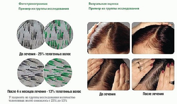 Vitamin cho tóc rụng và mọc. Đánh giá tốt nhất từ ​​hiệu thuốc: thuốc hiệu quả và rẻ tiền