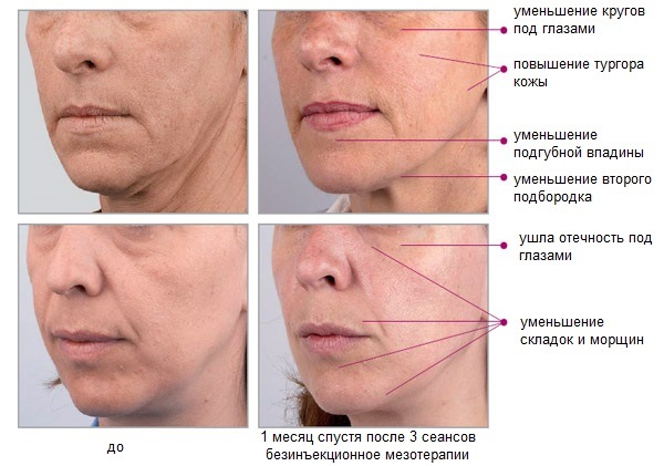 Mesotherapy phần cứng không tiêm trên khuôn mặt. Thủ tục này là gì, lợi ích, hiệu quả, giá cả