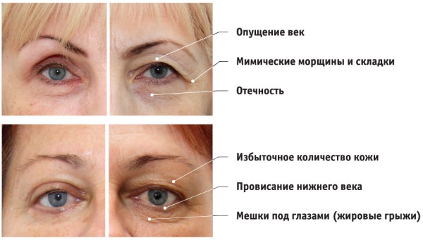 Blepharoplasty. Hình ảnh sau phẫu thuật theo ngày. Các biến chứng, phục hồi sau vòng tròn, dưới, trên. Phục hồi chức năng, hậu quả