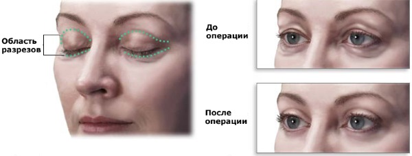 Blepharoplasty. Hình ảnh sau phẫu thuật theo ngày. Các biến chứng, phục hồi sau vòng tròn, dưới, trên. Phục hồi chức năng, hậu quả