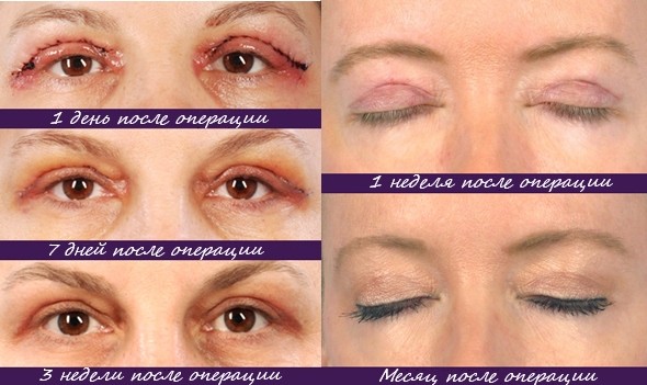 Blepharoplasty. Hình ảnh sau phẫu thuật theo ngày. Các biến chứng, phục hồi sau vòng tròn, dưới, trên. Phục hồi chức năng, hậu quả