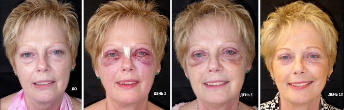 Blepharoplasty. Hình ảnh sau phẫu thuật theo ngày. Các biến chứng, phục hồi sau vòng tròn, dưới, trên. Phục hồi chức năng, hậu quả