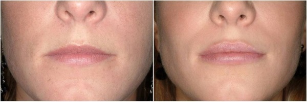 Tiêm botox cho các nếp nhăn trên khuôn mặt. Ảnh trước và sau, giá cả, hậu quả, chống chỉ định của thủ thuật