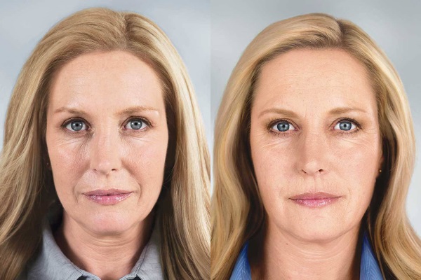 Tiêm botox cho các nếp nhăn trên khuôn mặt. Ảnh trước và sau, giá cả, hậu quả, chống chỉ định của thủ thuật