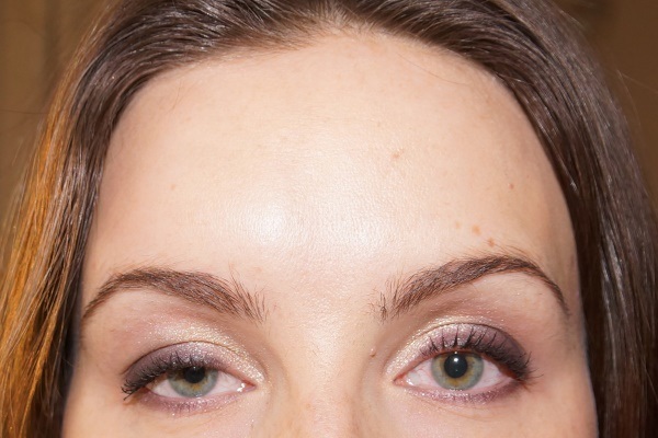 Tiêm botox cho các nếp nhăn trên khuôn mặt. Ảnh trước và sau, giá cả, hậu quả, chống chỉ định của thủ thuật