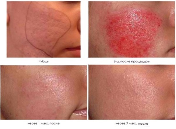 Dermapen: บทวิจารณ์ของขั้นตอนด้วยเครื่องมือฟิลเลอร์สำหรับการทำ Mesotherapy แบบเศษส่วน ซื้อที่ไหนวิธีใช้