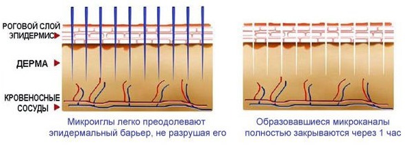 Dermapen: บทวิจารณ์ของขั้นตอนด้วยเครื่องมือฟิลเลอร์สำหรับการทำ Mesotherapy แบบเศษส่วน ซื้อที่ไหนวิธีใช้
