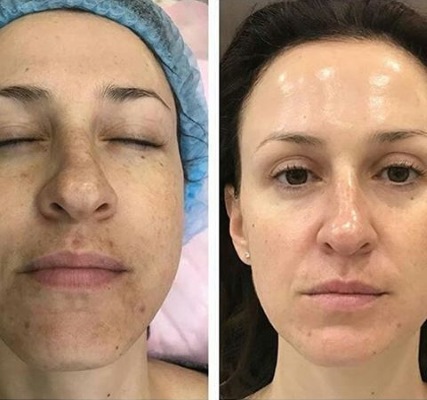 Dermapen: บทวิจารณ์ของขั้นตอนด้วยเครื่องมือฟิลเลอร์สำหรับการทำ Mesotherapy แบบเศษส่วน ซื้อที่ไหนวิธีใช้