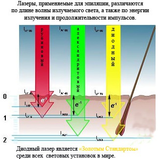 Диодно ласерско уклањање длака. Апарати за поступак, припрему, како ласер ради. Рецензије, пре и после фотографија