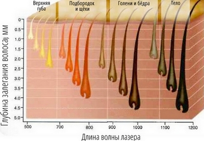 Диодно ласерско уклањање длака. Апарати за поступак, припрему, како ласер ради. Рецензије, пре и после фотографија