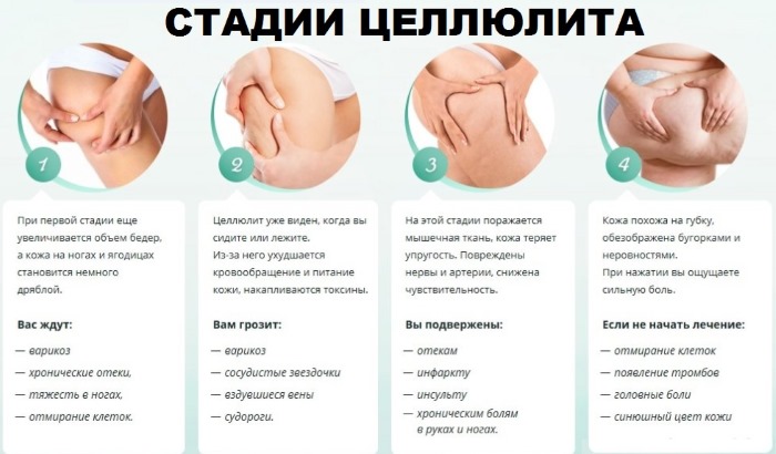 Làm thế nào để loại bỏ cellulite trên chân tại nhà: nhanh chóng, sau khi sinh con, phía sau, trên bắp chân. Tập thể dục, quấn, xoa bóp, ăn kiêng