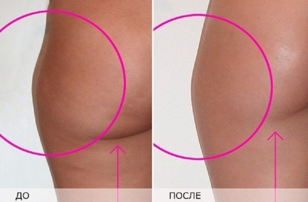 Làm thế nào để loại bỏ cellulite trên chân tại nhà: nhanh chóng, sau khi sinh con, phía sau, trên bắp chân. Tập thể dục, quấn, xoa bóp, ăn kiêng