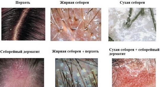 Viên nang mở rộng tóc. Các loại, ưu nhược điểm, hậu quả, bao nhiêu là đủ, giá bao nhiêu, cách loại bỏ. Cái nào tốt hơn: viên nang hoặc băng