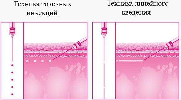 Цоллост - шта је то, прегледи козметолога. Упутства за употребу лека за ожиљке, стрије, цена