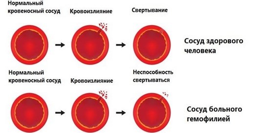 Цоллост - шта је то, прегледи козметолога. Упутства за употребу лека за ожиљке, стрије, цена