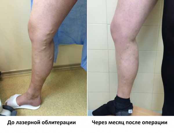 Ласерско уклањање вена на ногама са варикозним венама. Како иде операција, постоперативни период, рехабилитација, последице, компликације