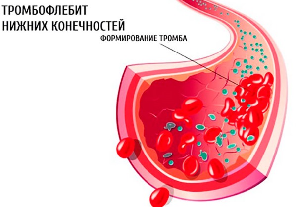 Ласерско уклањање вена на ногама са варикозним венама. Како иде операција, постоперативни период, рехабилитација, последице, компликације