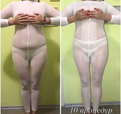 ЛПГ масажа за лице и тело. Рецензије, пре и после фотографија, ефикасност