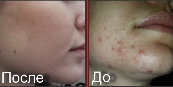 Gel trị mụn Metrogyl. Nhận xét của bác sĩ và người mua, thành phần, hiệu quả, hướng dẫn sử dụng
