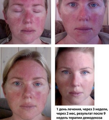 Gel trị mụn Metrogyl. Nhận xét của bác sĩ và người mua, thành phần, hiệu quả, hướng dẫn sử dụng