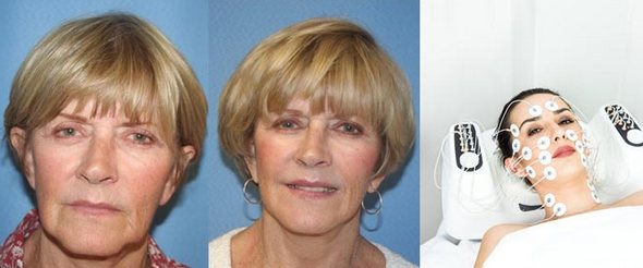 Myostimulation: nó là gì, hiệu quả, chỉ định và chống chỉ định, chi phí, thiết bị để thực hiện thủ thuật tại nhà