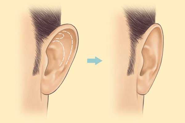 جراحة تجميل الوجه. صور قبل وبعد جراحة نحت الجسم بحمض الهيالورونيك. الأسعار والاستعراضات
