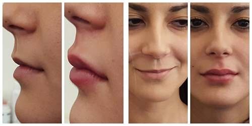 جراحة تجميل الوجه. صور قبل وبعد جراحة نحت الجسم بحمض الهيالورونيك. الأسعار والاستعراضات