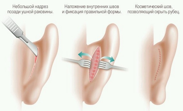 جراحة تجميل الوجه. صور قبل وبعد جراحة نحت الجسم بحمض الهيالورونيك. الأسعار والاستعراضات