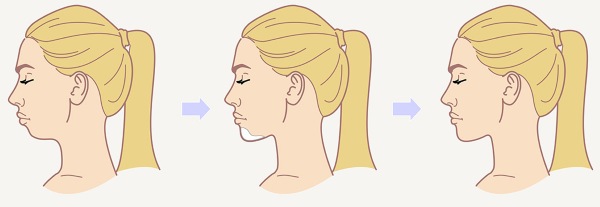 جراحة تجميل الوجه. صور قبل وبعد جراحة نحت الجسم بحمض الهيالورونيك. الأسعار والاستعراضات