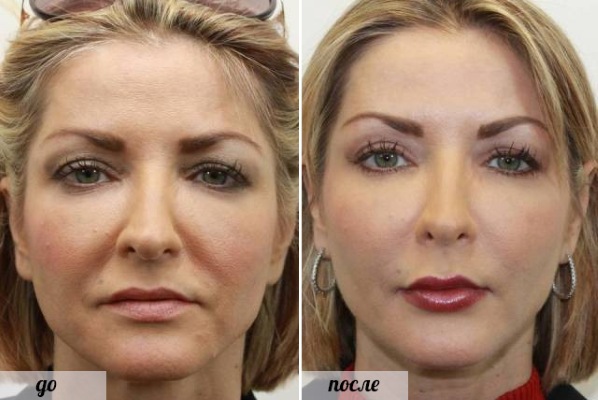 جراحة تجميل الوجه. صور قبل وبعد جراحة نحت الجسم بحمض الهيالورونيك. الأسعار والاستعراضات