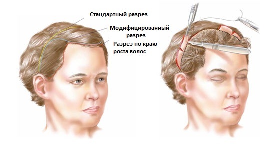 جراحة تجميل الوجه. صور قبل وبعد جراحة نحت الجسم بحمض الهيالورونيك. الأسعار والاستعراضات