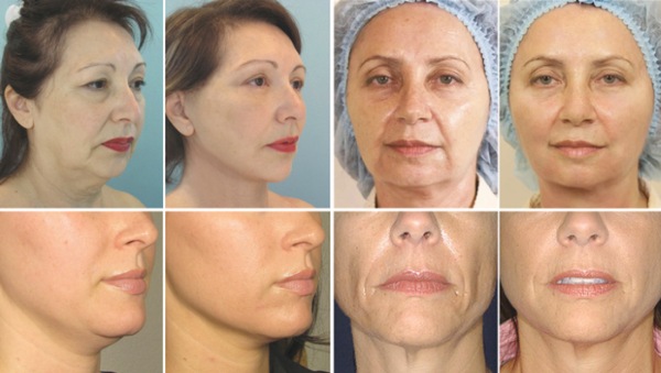 جراحة تجميل الوجه. صور قبل وبعد جراحة نحت الجسم بحمض الهيالورونيك. الأسعار والاستعراضات