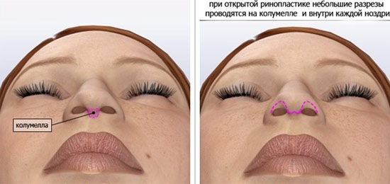 جراحة تجميل الوجه. صور قبل وبعد جراحة نحت الجسم بحمض الهيالورونيك. الأسعار والاستعراضات