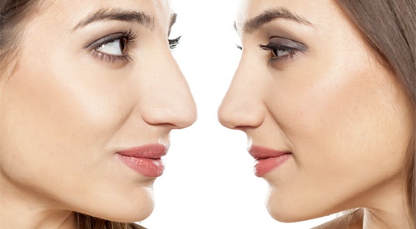 جراحة تجميل الوجه. صور قبل وبعد جراحة نحت الجسم بحمض الهيالورونيك. الأسعار والاستعراضات