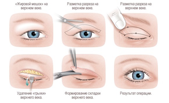 جراحة تجميل الوجه. صور قبل وبعد جراحة نحت الجسم بحمض الهيالورونيك. الأسعار والاستعراضات