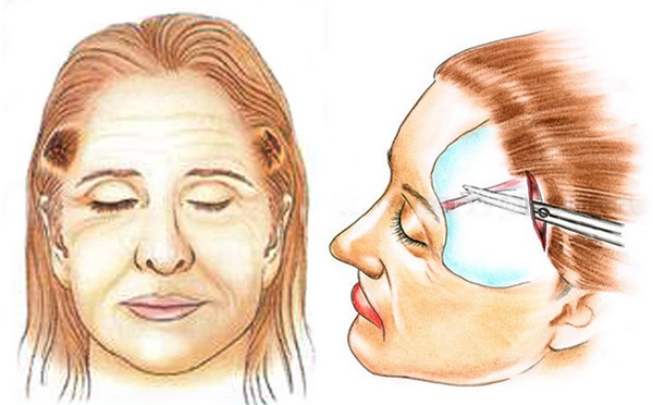 جراحة تجميل الوجه. صور قبل وبعد جراحة نحت الجسم بحمض الهيالورونيك. الأسعار والاستعراضات