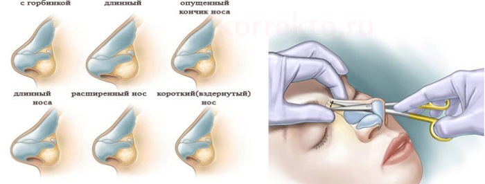 جراحة تجميل الوجه. صور قبل وبعد جراحة نحت الجسم بحمض الهيالورونيك. الأسعار والاستعراضات