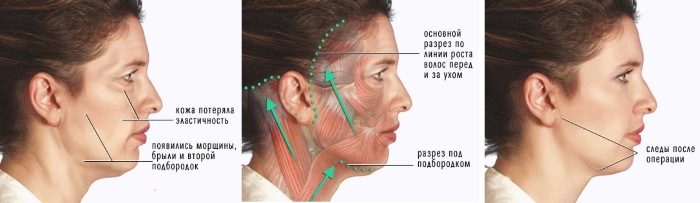 جراحة تجميل الوجه. صور قبل وبعد جراحة نحت الجسم بحمض الهيالورونيك. الأسعار والاستعراضات