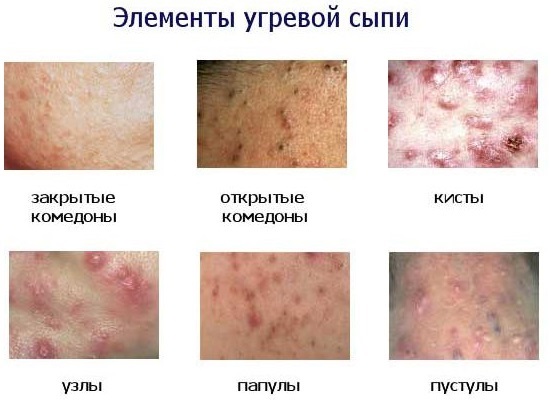 حب الشباب على الظهر عند النساء والرجال. أسباب المظهر وكيفية العلاج إزالته بسرعة في المنزل