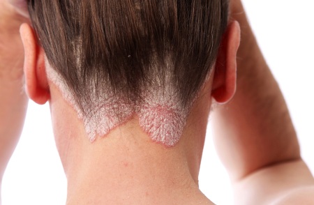 Dầu gội Sebozol trị gàu và tăng tiết bã nhờn. Chỉ định sử dụng, thành phần, chất tương tự giá rẻ, giá cả và đánh giá