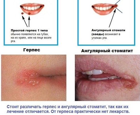 Разлози због којих се усне суше код жена, мушкараца. Како лечити прехладу, САРС, менопаузу, дијабетес, онкологију, током трудноће