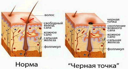 Како се решити митесера на лицу, носу, ушима. Производи са салицилном киселином, зубном пастом, пероксидом, активним угљем