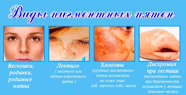 علاجات للبقع العمرية على الوجه واليدين. وصفات شعبية ، مستحضرات صيدلية ، كريمات: Melanativ ، Vichy ، Sabainang. كيفية التقديم
