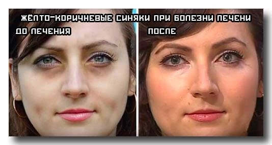 Quầng thâm dưới mắt, quầng thâm quanh mắt. Nguyên nhân và cách điều trị ở phụ nữ và nam giới