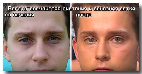 Quầng thâm dưới mắt, quầng thâm quanh mắt. Nguyên nhân và cách điều trị ở phụ nữ và nam giới
