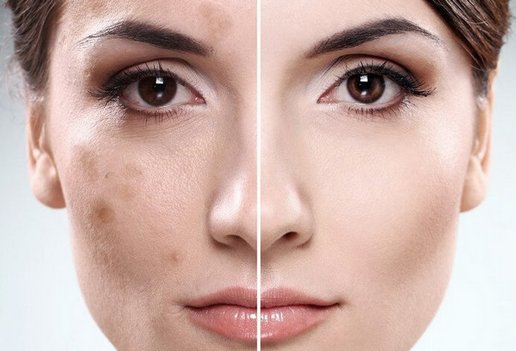 Kem Achromin cho các đốm đồi mồi. Nhận xét của bác sĩ, hướng dẫn sử dụng, chỉ định và chống chỉ định, hình ảnh trước và sau