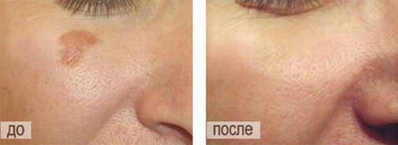 Kem Achromin cho các đốm đồi mồi. Nhận xét của bác sĩ, hướng dẫn sử dụng, chỉ định và chống chỉ định, hình ảnh trước và sau