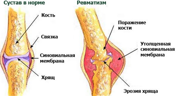 Bọc cơ thể chống cellulite với dầu, đất sét, mù tạt, mật ong, giấm, cà phê. Công thức, quy tắc sử dụng tại nhà